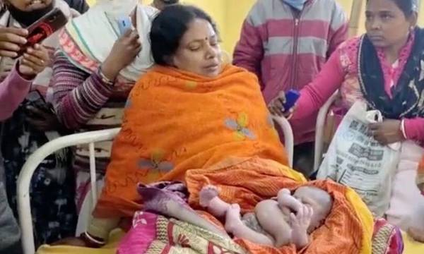 Απίστευτo: Μωρό γεννήθηκε με 4 πόδια και 4 χέρια στην Ινδία - Σκληρές εικόνες