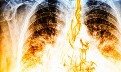Γιατί κάποιοι καπνιστές εμφανίζουν καρκίνο στον πνεύμονα και άλλοι όχι