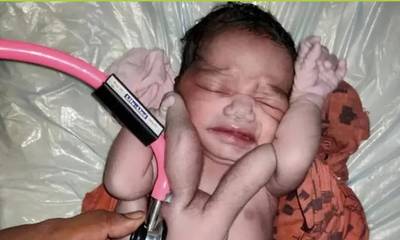Ινδία: Μωρό «μετενσάρκωση του Θεού» γεννήθηκε με τέσσερα χέρια και τέσσερα πόδια