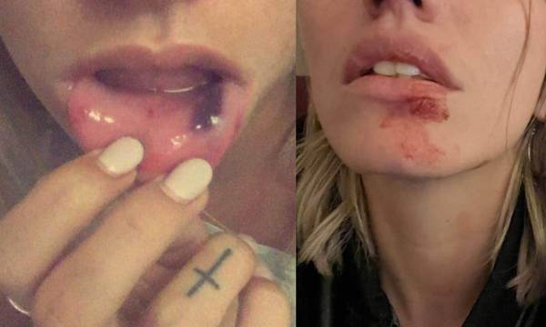 Φωτογραφίες ντοκουμέντo: Μοντέλο δέχθηκε επίθεση από τον πρώην της - «Μου έριξε μπουνιά στο σαγόνι»