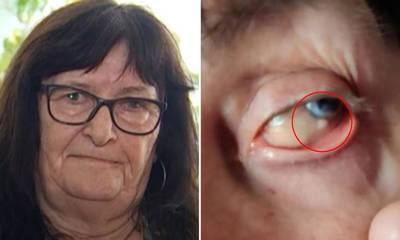 Είχε μια πέτρα στο μάτι της επί 50 χρόνια – Γιατροί την θεωρούσαν τρελή