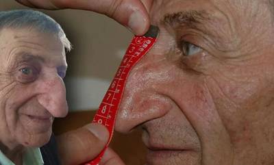 Τουρκία: Πέθανε ξαφνικά ο άνθρωπος με την μακρύτερη μύτη στον κόσμο