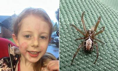 5χρονη στη Βρετανία γέμισε εξανθήματα και δεν μπορούσε να περπατήσει από τσίμπημα αράχνης